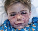 Pit bull attack - Conner Landers