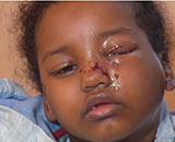 Pit bull attack - Sumaya Farah Ali