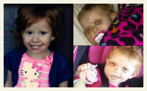 doctors restore little girls face Payton Bronish